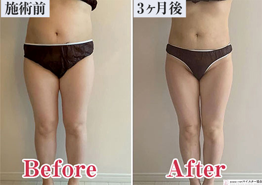 before-after_産後_02